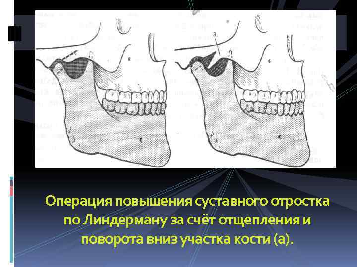 Анкилоз челюсти. Анкилоз ВНЧС патогенез. Анкилоз височно-нижнечелюстного сустава. Двусторонний костный анкилоз ВНЧС.