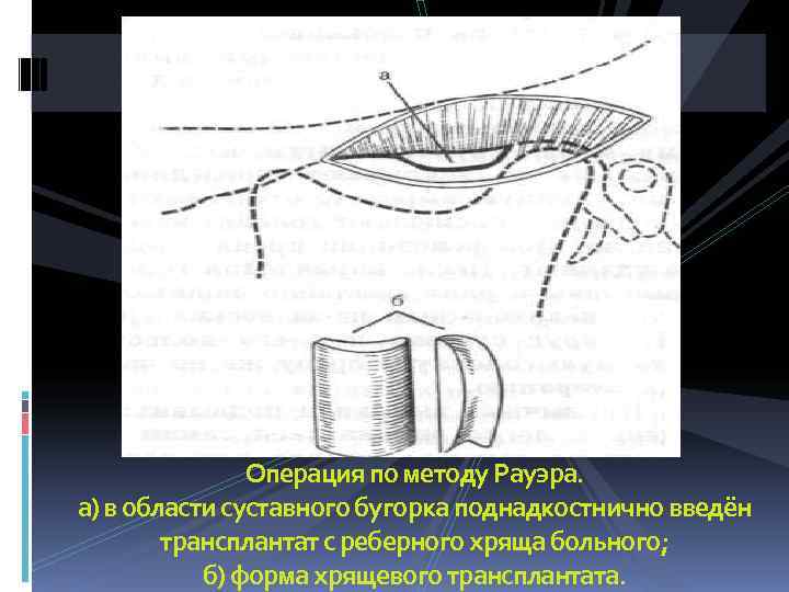     Операция по методу Рауэра. а) в области суставного бугорка поднадкостнично