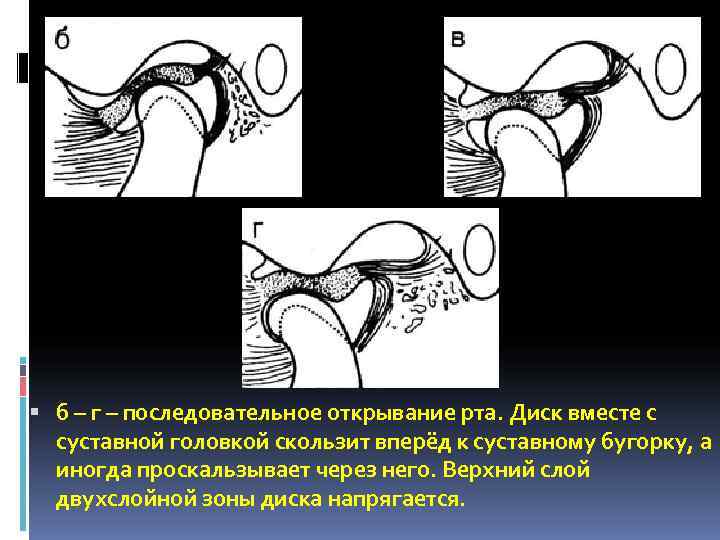  б – г – последовательное открывание рта. Диск вместе с  суставной головкой