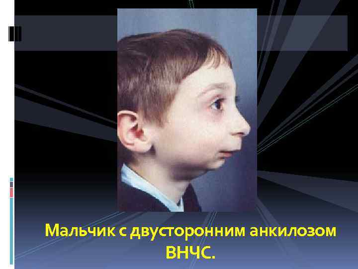 Мальчик с двусторонним анкилозом    ВНЧС. 