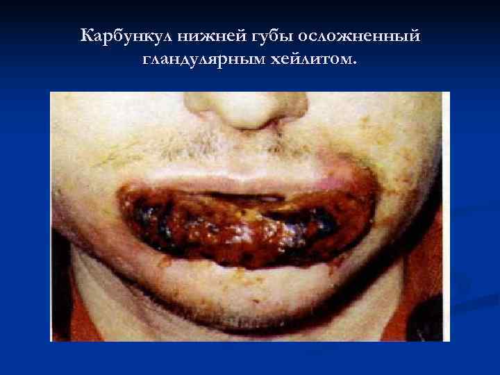 Карбункул нижней губы осложненный  гландулярным хейлитом. 