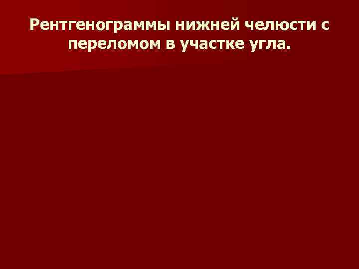 Рентгенограммы нижней челюсти с переломом в участке угла. Рентгенограммы нижней челюсти с переломом в участке угла.