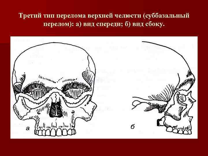 Третий тип перелома верхней челюсти (суббазальный перелом): а) вид спереди; б) вид сбоку. Третий тип перелома верхней челюсти (суббазальный перелом): а) вид спереди; б) вид сбоку.