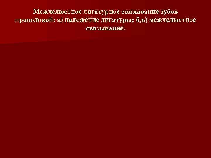 Межчелюстное лигатурное связывание зубов проволокой: а) наложение лигатуры; б, в) межчелюстное Межчелюстное лигатурное связывание зубов проволокой: а) наложение лигатуры; б, в) межчелюстное