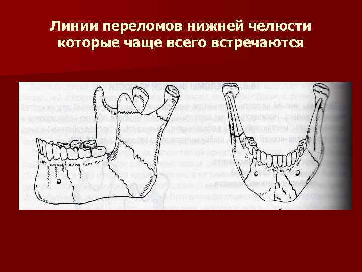 Перелом нижней челюсти карта вызова