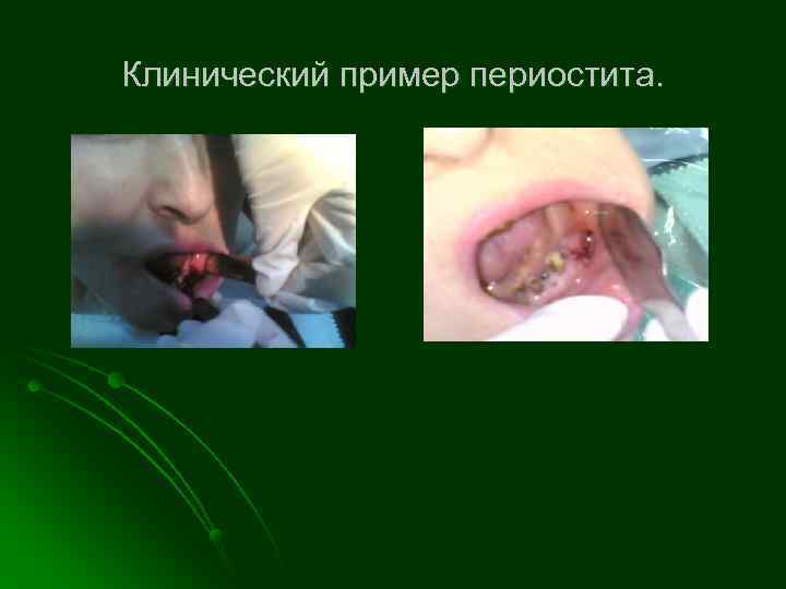 Клинический пример периостита. 