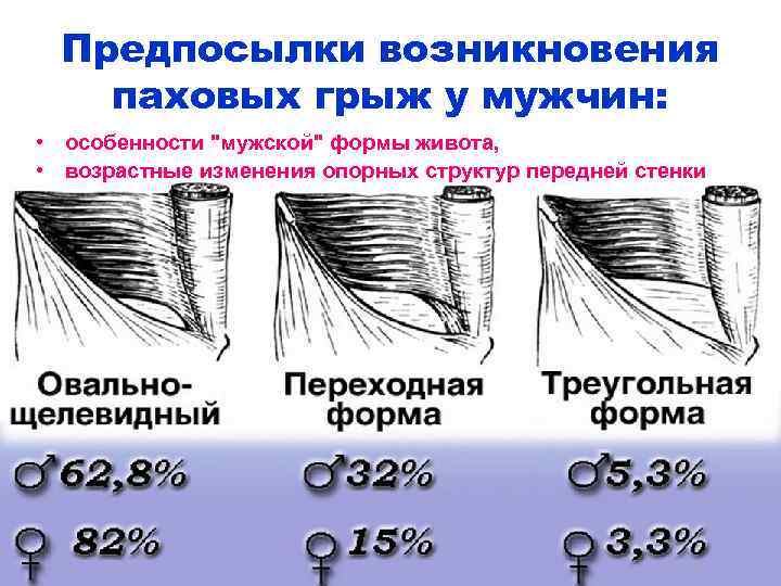 Предпосылки возникновения паховых грыж у мужчин: • особенности 