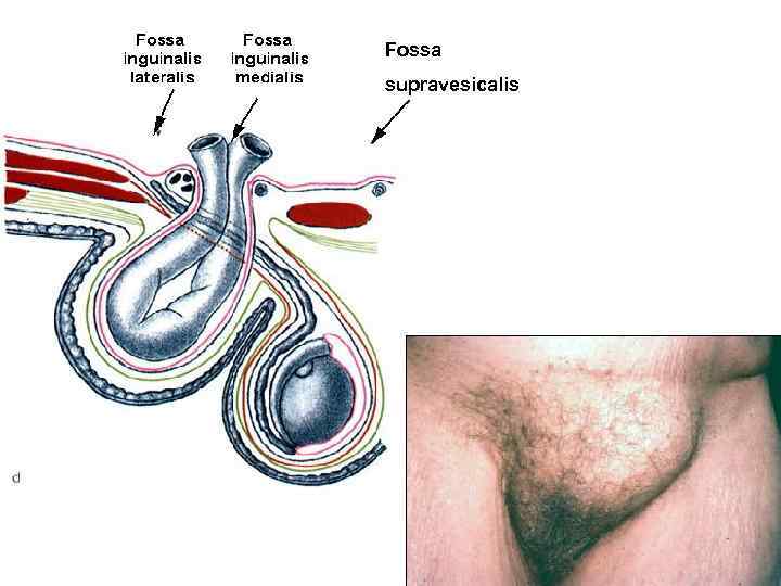 Fossa supravesicalis 