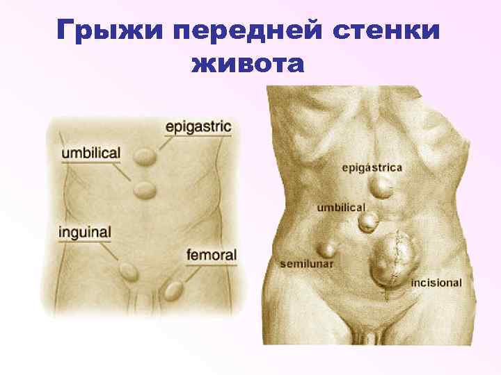 Грыжи передней стенки живота 