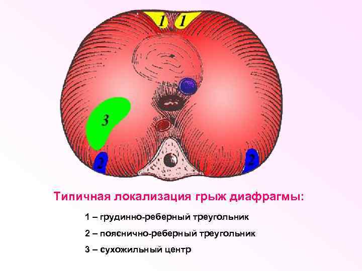 Типичная локализация грыж диафрагмы: 1 – грудинно-реберный треугольник 2 – пояснично-реберный треугольник 3 –