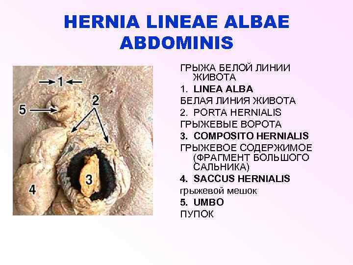 HERNIA LINEAE ALBAE ABDOMINIS ГРЫЖА БЕЛОЙ ЛИНИИ ЖИВОТА 1. LINEA ALBA БЕЛАЯ ЛИНИЯ ЖИВОТА