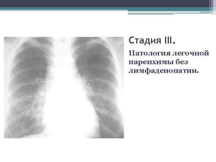 Стадия III. Патология легочной паренхимы без лимфаденопатии. 