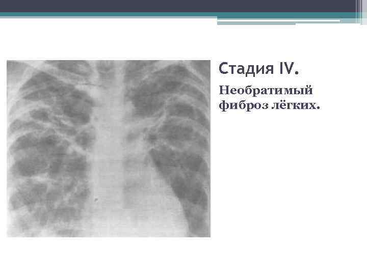 Фиброз легких что это. Саркоидоз Бека Шауманна. Линейный фиброз легких рентген. Саркоидоз (Бенье-Бека-Шауманна болезнь).