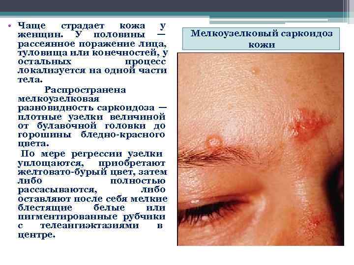  • Чаще страдает кожа у  женщин.  У половины —  