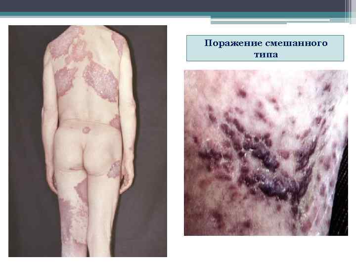 Поражение смешанного   типа 