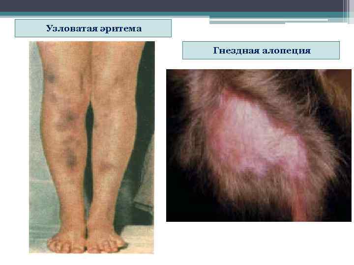 Узловатая эритема     Гнездная алопеция 