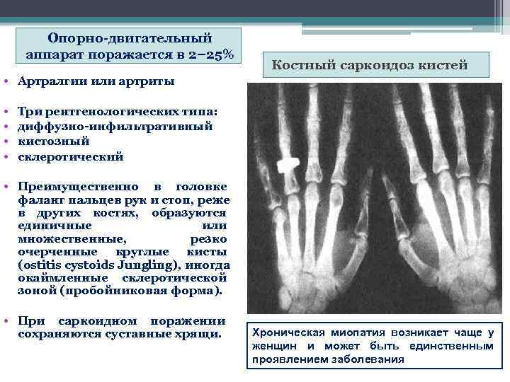   Опорно-двигательный  аппарат поражается в 2– 25%     Костный
