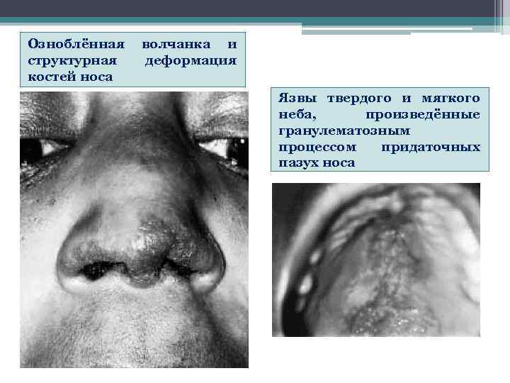 Озноблённая  волчанка и структурная  деформация костей носа     