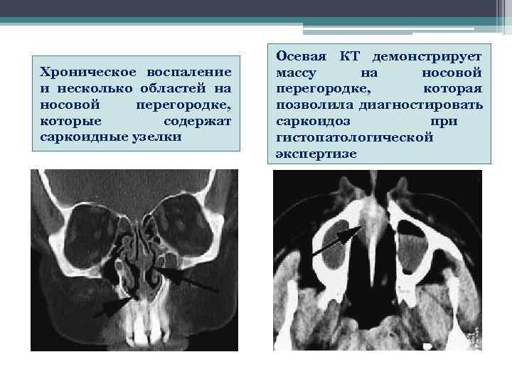     Осевая КТ демонстрирует Хроническое воспаление  массу на носовой