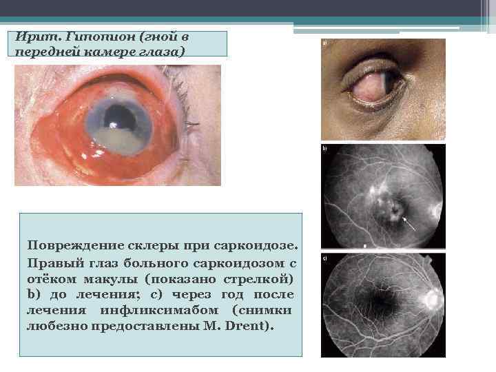 Ирит. Гипопион (гной в передней камере глаза) Повреждение склеры при саркоидозе.  Правый глаз