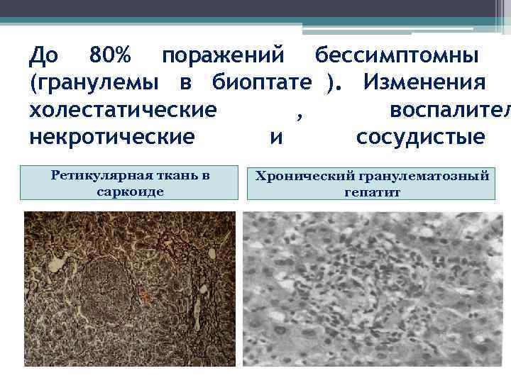 До 80% поражений бессимптомны (гранулемы в биоптате ). Изменения холестатические ,  воспалител некротические
