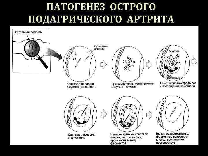 Подагра схема патогенеза