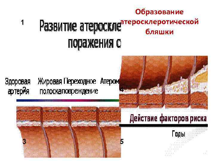  Образование 1  атеросклеротической  бляшки 2  4 3  5