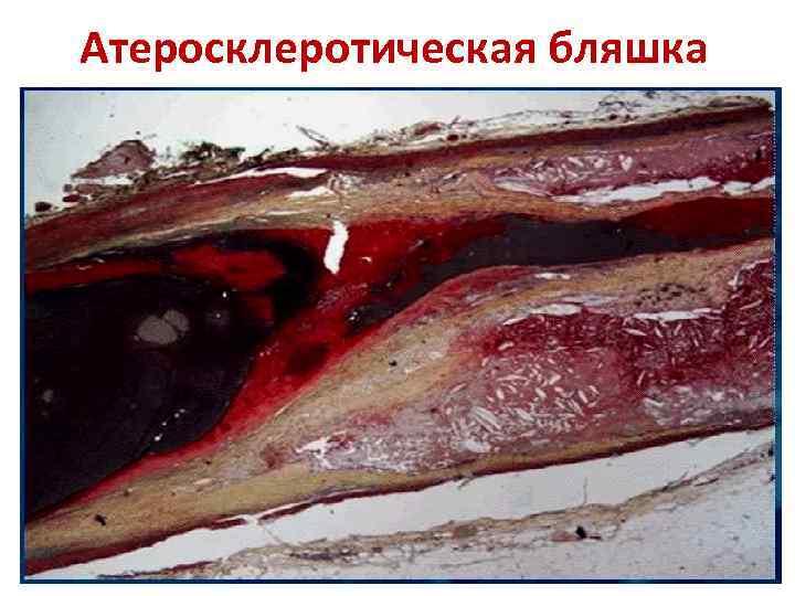 Атеросклеротическая бляшка 