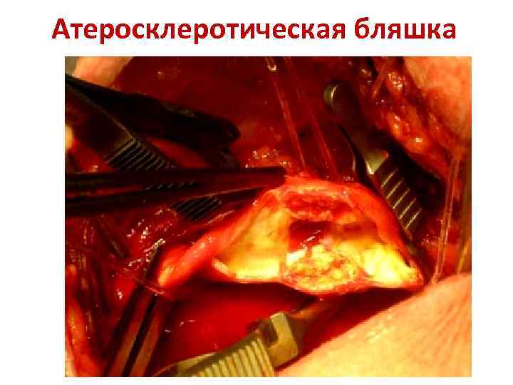 Атеросклеротическая бляшка 