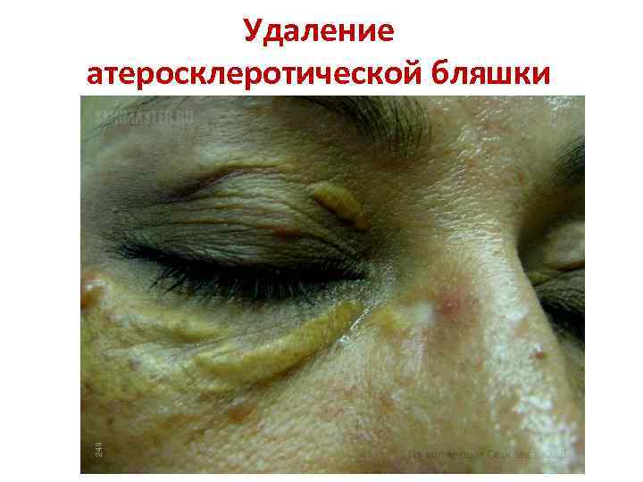    Удаление атеросклеротической бляшки 