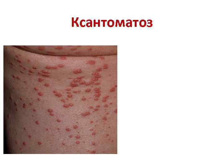 Ксантоматоз 