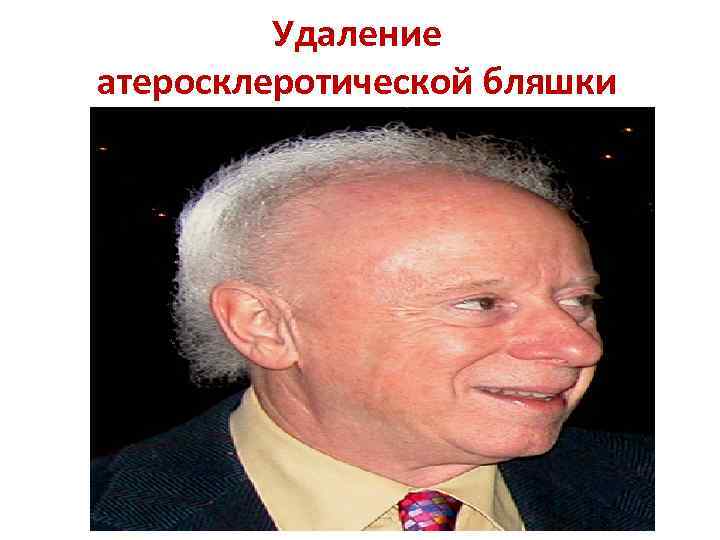    Удаление атеросклеротической бляшки 