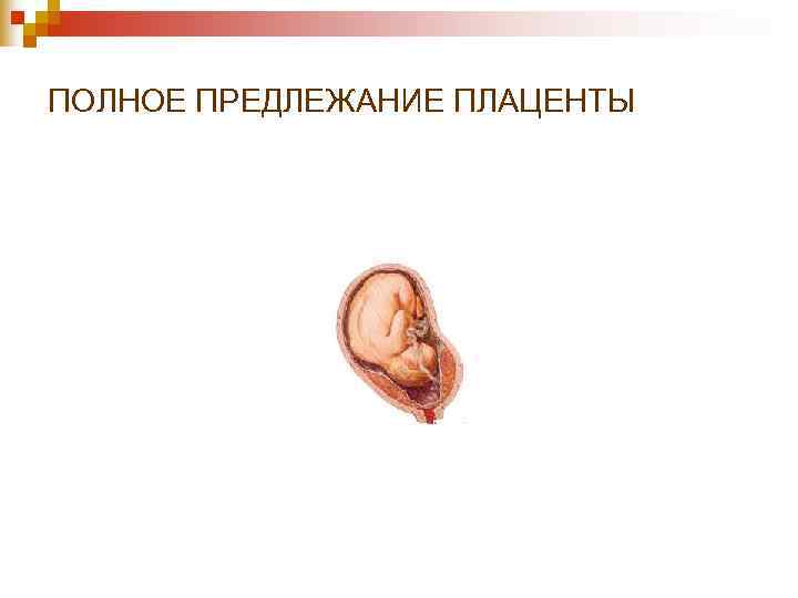 ПОЛНОЕ ПРЕДЛЕЖАНИЕ ПЛАЦЕНТЫ ПОЛНОЕ ПРЕДЛЕЖАНИЕ ПЛАЦЕНТЫ