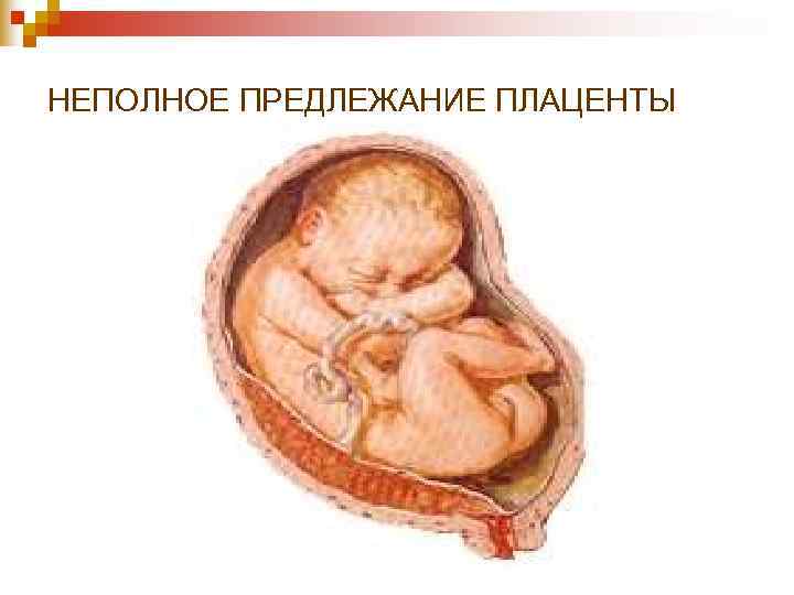 НЕПОЛНОЕ ПРЕДЛЕЖАНИЕ ПЛАЦЕНТЫ НЕПОЛНОЕ ПРЕДЛЕЖАНИЕ ПЛАЦЕНТЫ