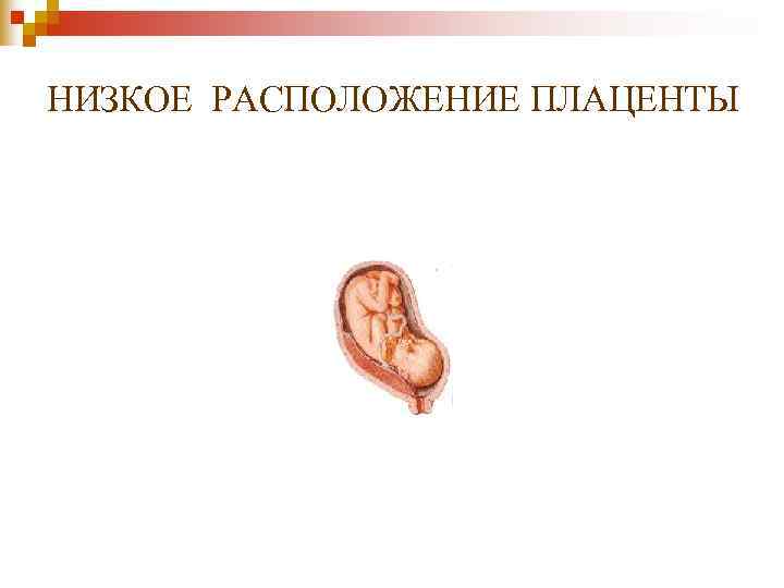 НИЗКОЕ РАСПОЛОЖЕНИЕ ПЛАЦЕНТЫ НИЗКОЕ РАСПОЛОЖЕНИЕ ПЛАЦЕНТЫ