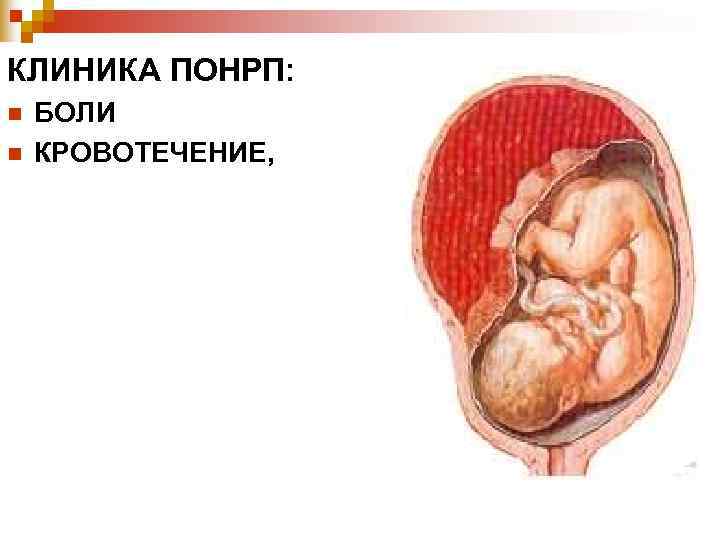 КЛИНИКА ПОНРП: n БОЛИ n КРОВОТЕЧЕНИЕ, КЛИНИКА ПОНРП: n БОЛИ n КРОВОТЕЧЕНИЕ,