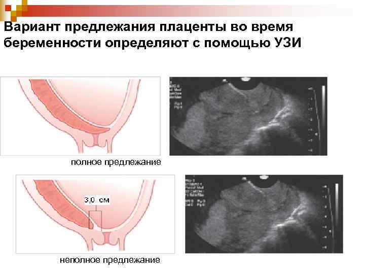 Вариант предлежания плаценты во время беременности определяют с помощью УЗИ полное предлежание Вариант предлежания плаценты во время беременности определяют с помощью УЗИ полное предлежание