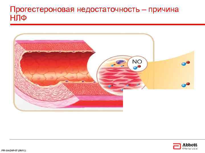  Прогестероновая недостаточность – причина  НЛФ PR-UA-DUP-07 (09/11) 