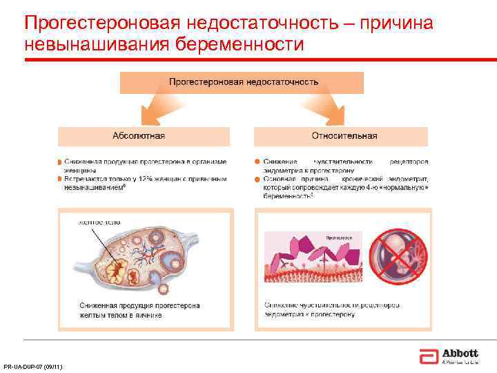  Прогестероновая недостаточность – причина  невынашивания беременности PR-UA-DUP-07 (09/11) 