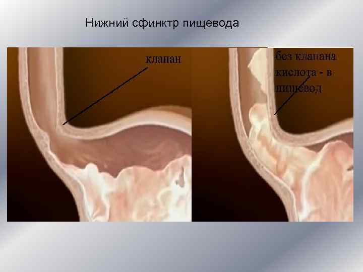 Нижний сфинктр пищевода 
