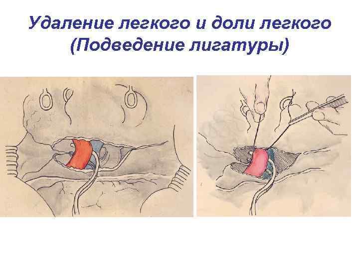 Удаление доли. Операция по удалению доли легкого.