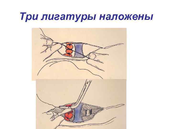 Три лигатуры наложены 