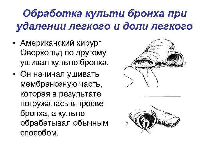 Обработка культи бронха при удалении легкого и доли легкого • Американский хирург Оверхольд по