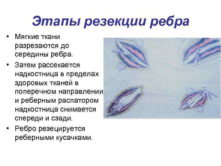 Резекция ребра презентация