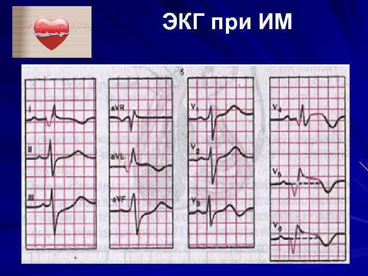 ЭКГ при ИМ ЭКГ при ИМ