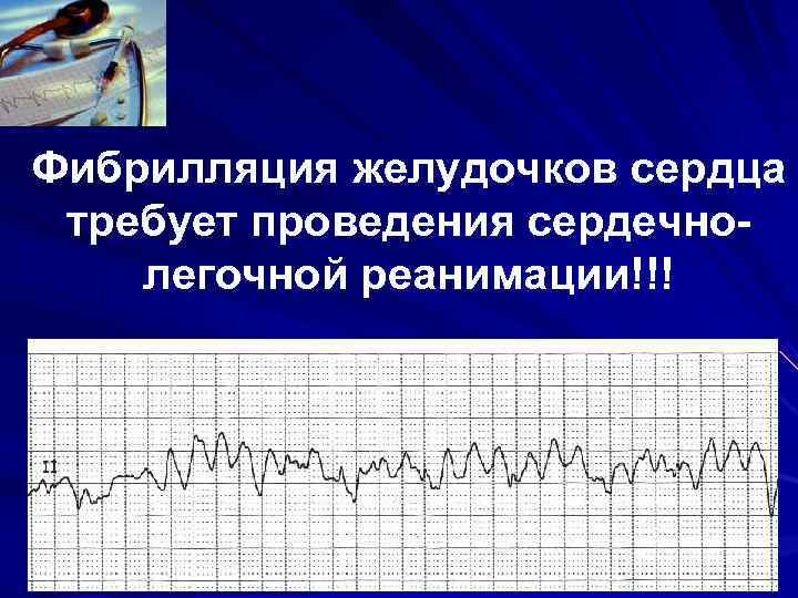 Фибрилляция желудочков сердца требует проведения сердечно- легочной реанимации!!! Фибрилляция желудочков сердца требует проведения сердечно- легочной реанимации!!!