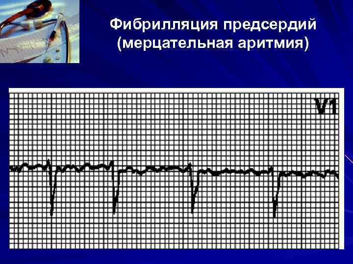 Фибрилляция предсердий (мерцательная аритмия) Фибрилляция предсердий (мерцательная аритмия)