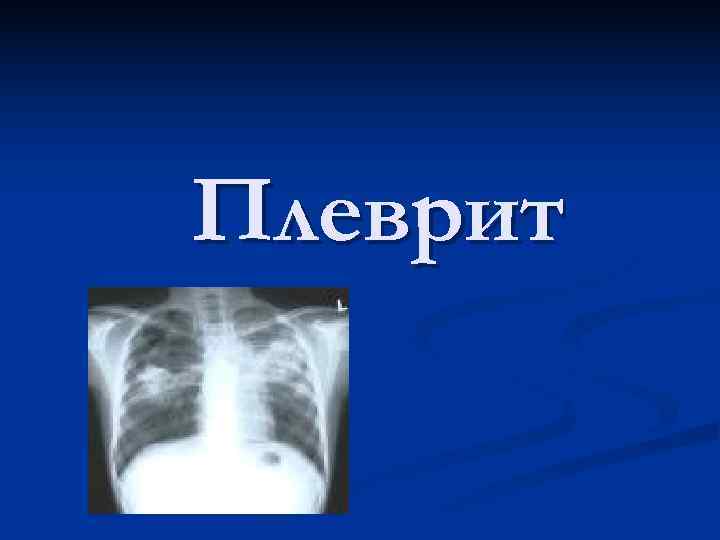Плеврит 