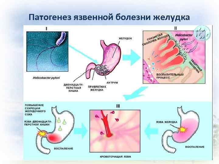 Патогенез язвенной болезни желудка 