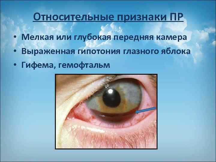 Относительные признаки ПР • Мелкая или глубокая передняя камера • Выраженная гипотония глазного яблока
